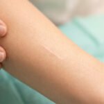 Gros plan sur un avant-bras présentant une cicatrice linéaire pâle. Une main aux ongles clairs touche la peau sur un fond médical vert flou.